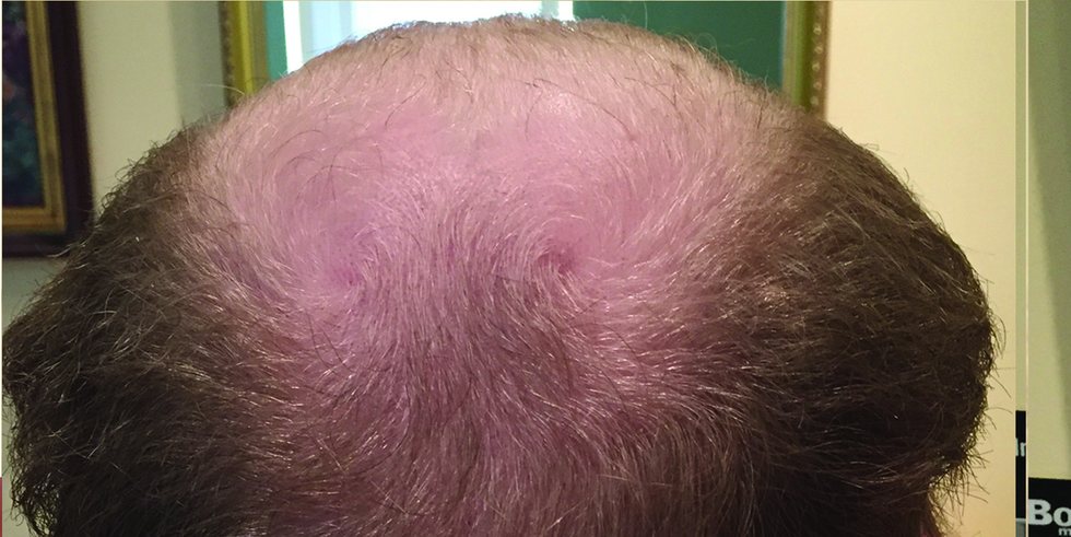 Before: crown thinning