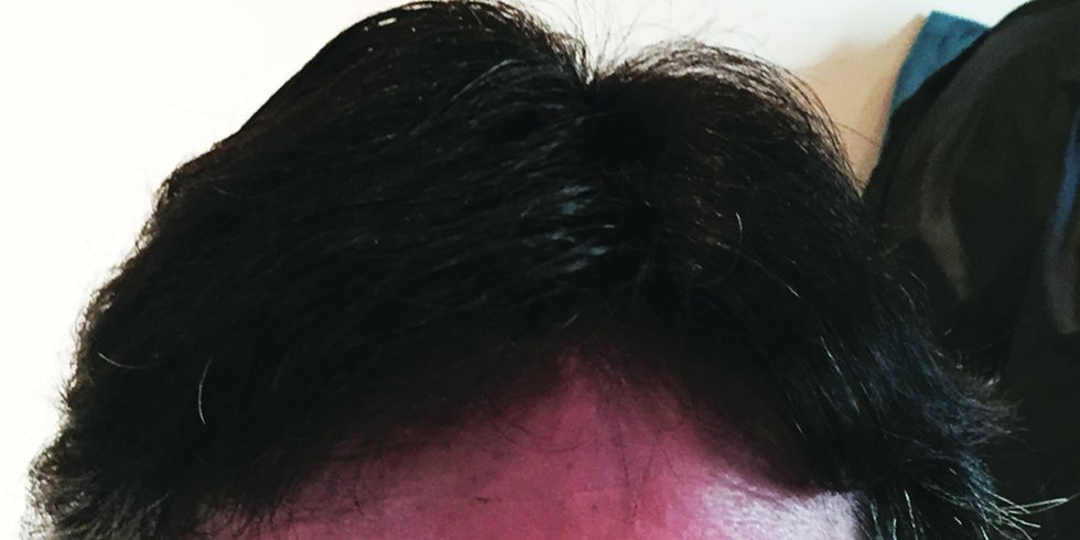 After: full head of brown hair
