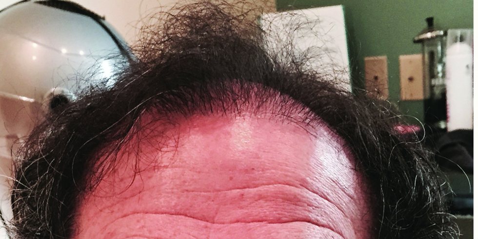 Before: advanced male pattern baldness