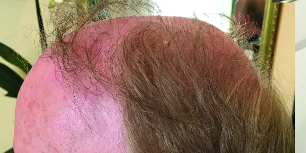 Before: sparse thinning hair