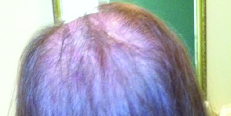 Before: thinning at the temples