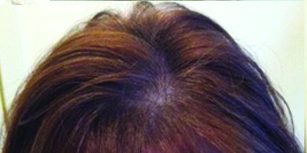 Before: thinning at the part and crown