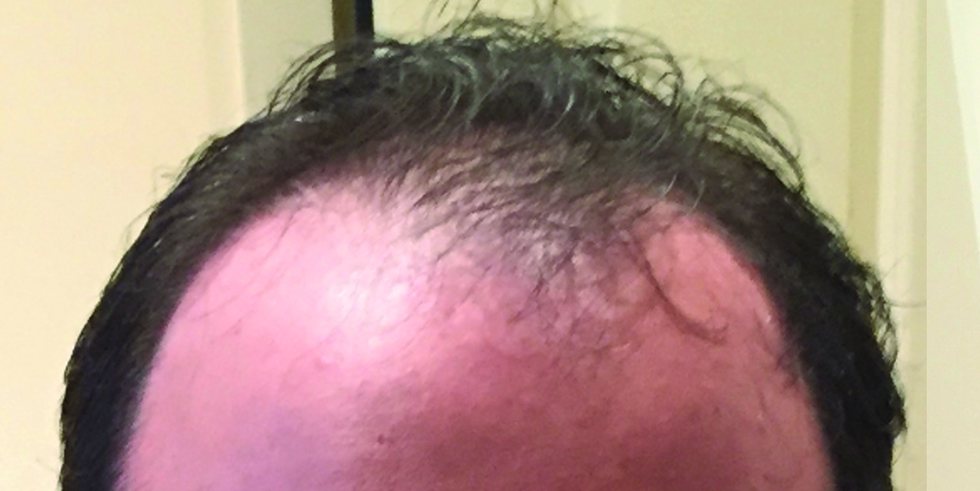 Before: visible scalp through thinning hair