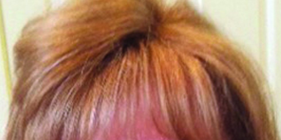 After: healthy, full head of hair