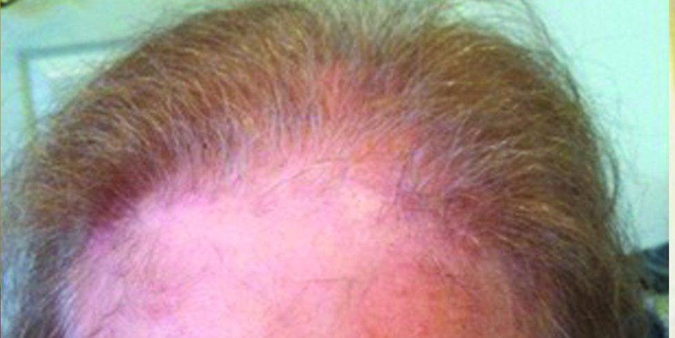 Before: advanced thinning at the crown